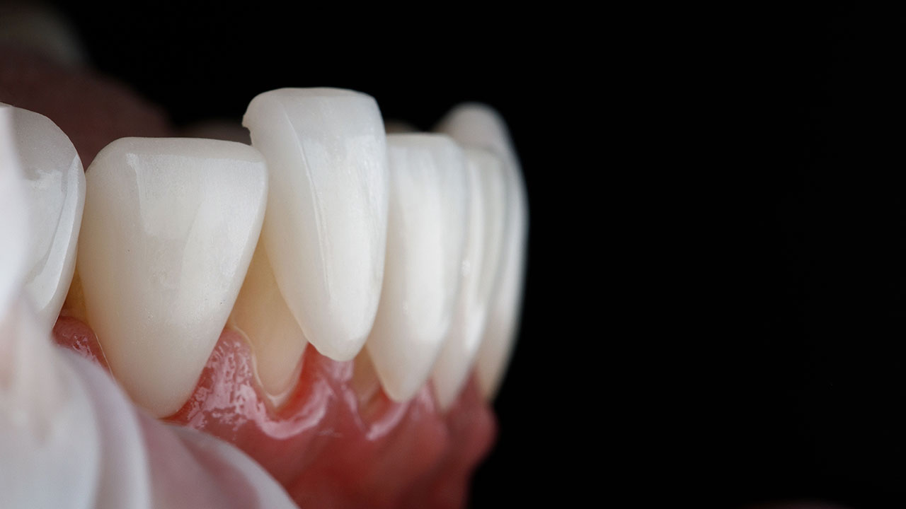 Fisher Dental | Dental Veneers in Murfreesboro: How Many Teeth Should You Treat?