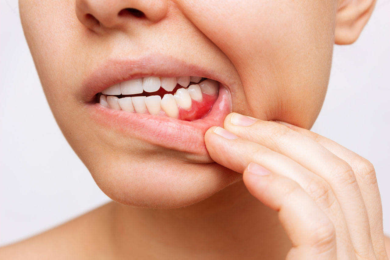 Fisher Dental | Gum Disease Treatment in Murfreesboro: Early Signs You Should Not Ignore