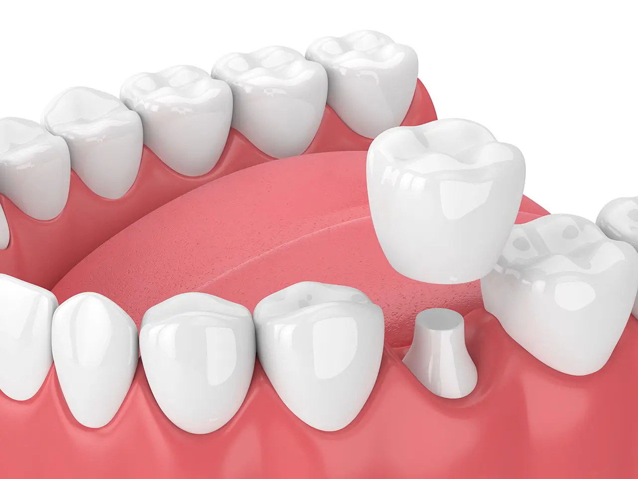 Fisher Dental | Dental Crowns in Murfreesboro: When Does a Damaged Tooth Need a Crown? Fisher Dental | Dental Crowns in Murfreesboro: When Does a Damaged Tooth Need a Crown?