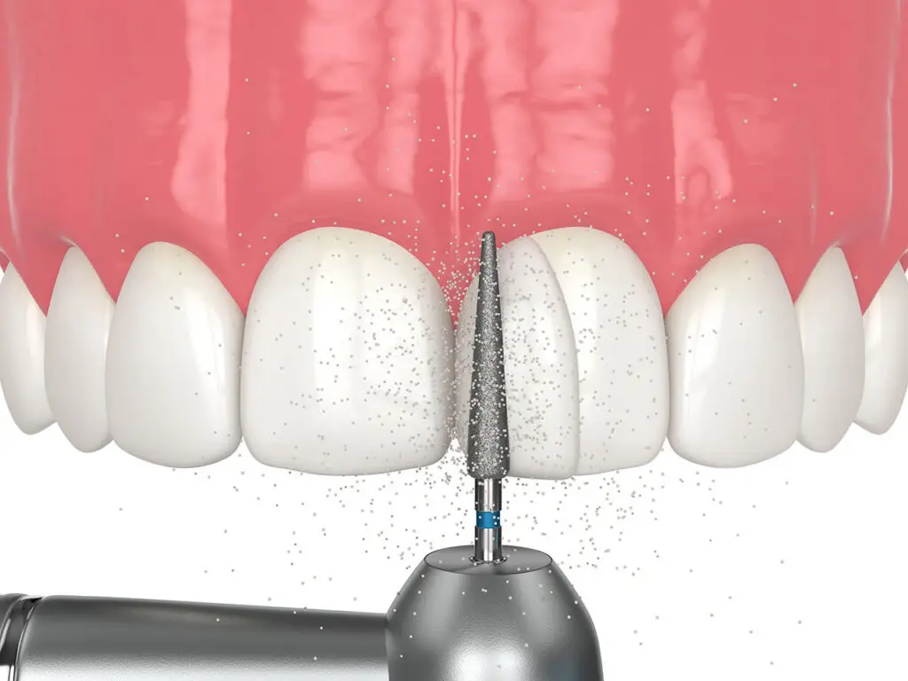Fisher Dental | Tooth Bonding in Murfreesboro: What Can Cosmetic Bonding Fix? Fisher Dental | Tooth Bonding in Murfreesboro: What Can Cosmetic Bonding Fix?