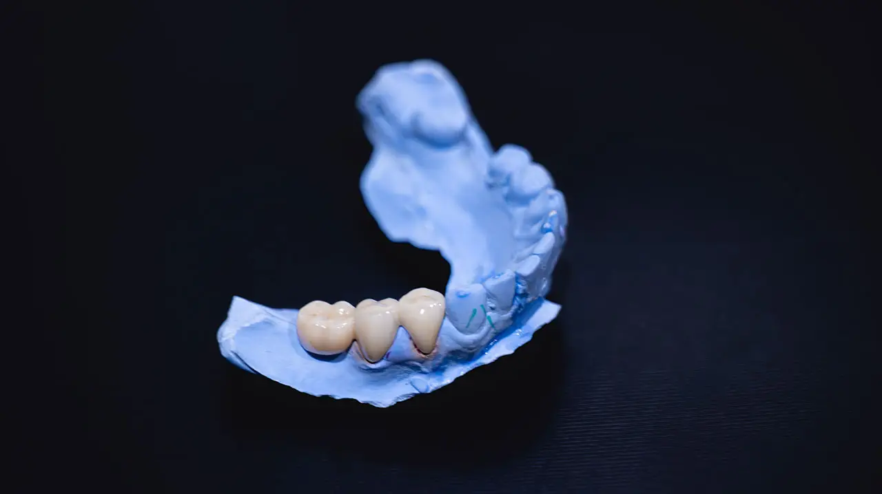 Fisher Dental | Dental Bridges in Murfreesboro: How Can You Replace a Missing Tooth Without a Removable Denture? Fisher Dental | Dental Bridges in Murfreesboro: How Can You Replace a Missing Tooth Without a Removable Denture?
